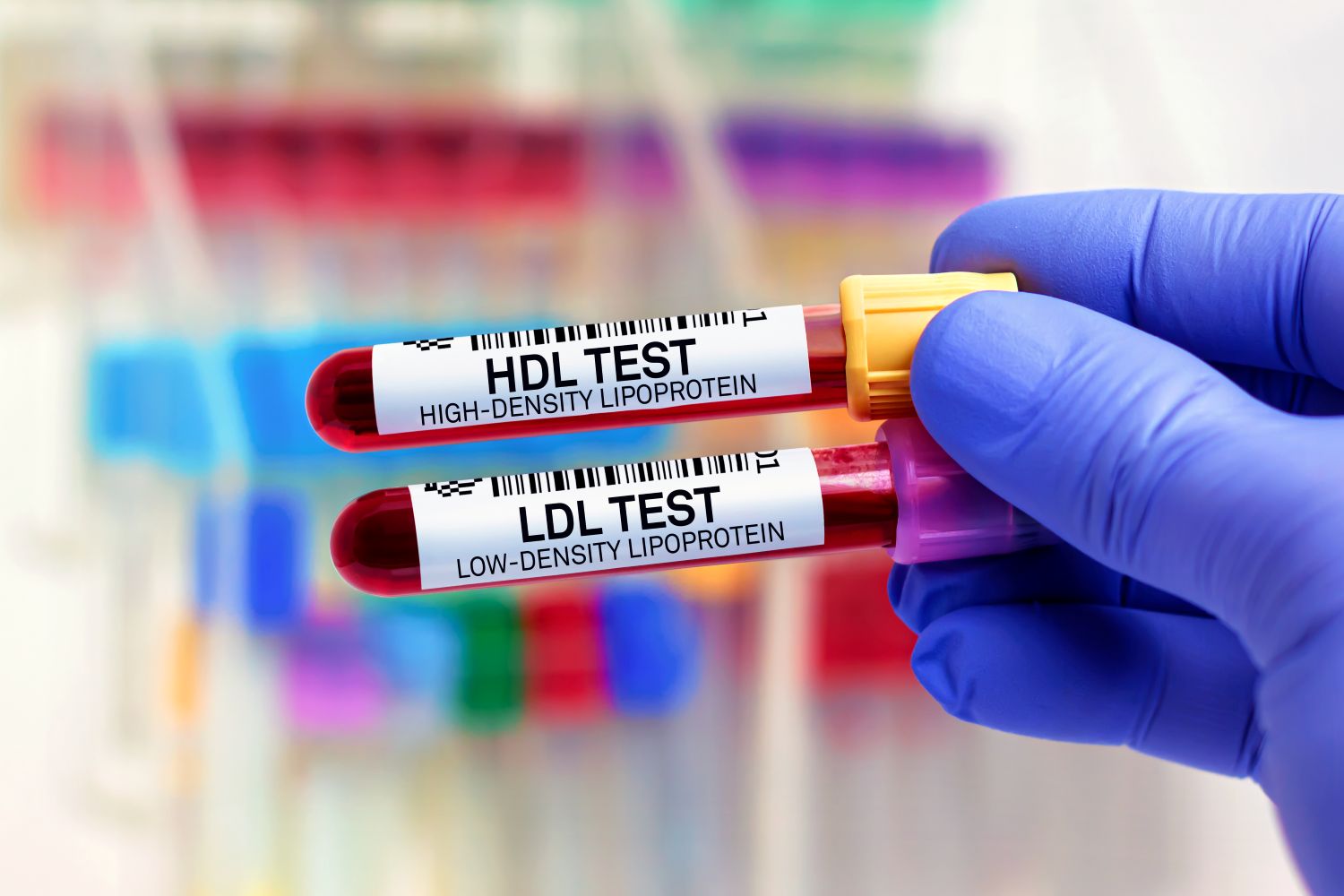 You’ve had your cholesterol checked, opened the results, and found yourself looking at a collection of numbers and abbreviations. Perhaps your LDL is a little high. Your HDL looks good. Your triglycerides fall somewhere in between. So, how concerned should you be? The answer depends on how those numbers fit into your overall health.